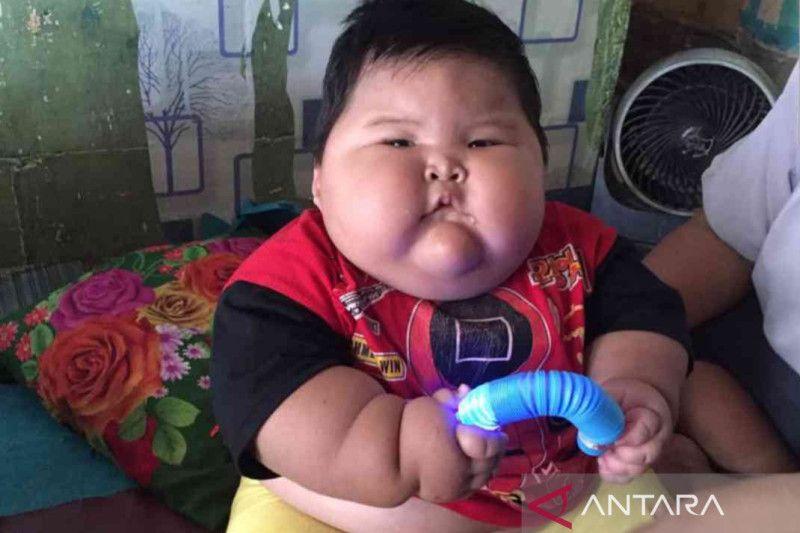 Dirujuk ke RSCM, Balita Obesitas Kemungkinan Alami Kelainan Genetika