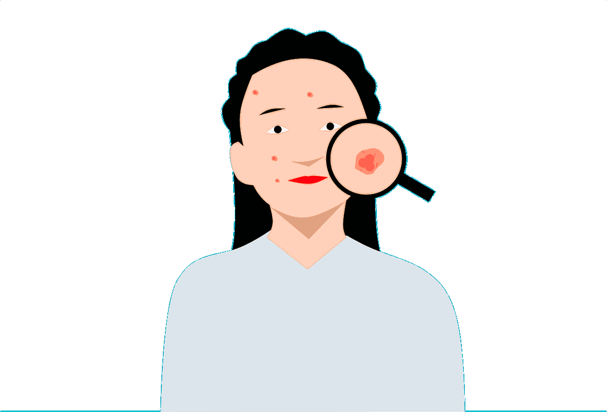 Kiat Atasi Jerawat dan Bibir Kering di Bulan Puasa