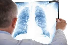 Orang yang Tak Merokok Dapat Cegah Pneumonia