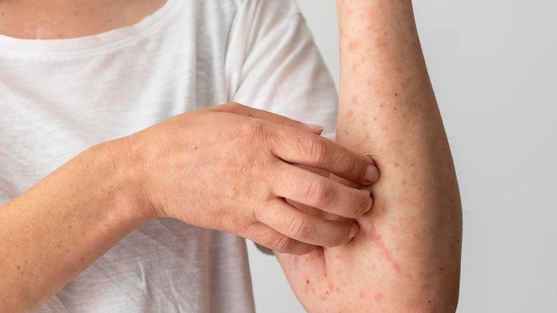 Dokter Penyakit Dalam: Istirahat yang Cukup Kurangi Risiko Terserang Lupus