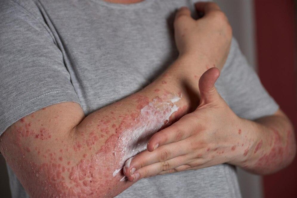 Ini yang Harus Dilakukan untuk Kurangi Risiko Terserang Lupus