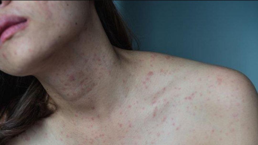 Penyakit Lupus 'Si Seribu Wajah' Tak Bisa Didiagnosis Mandiri, Perempuan Lebih Rentan Kena?