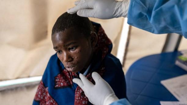 WHO Tegaskan Mpox Bukan COVID Varian Baru