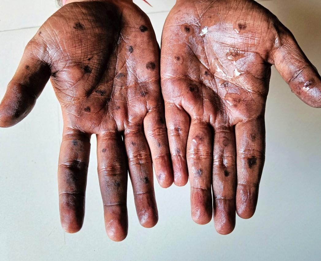 Dinkes Kepri Pastikan Seluruh Puskesmas Siap Tangani Mpox