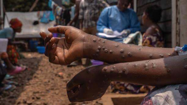 Ngeri! Nyaris 30.000 Kasus Cacar Monyet Melanda Afrika pada 2024