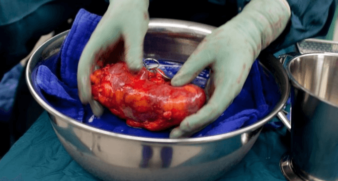 Jual Ginjal, Mengungkap Jaringan Perdagangan Organ Global