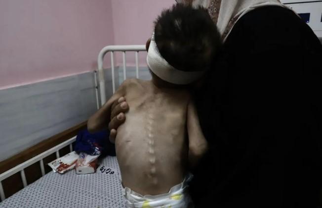 Krisis Gizi di Gaza Memburuk, Puluhan Warga Palestina Meninggal Akibat Malanutrisi
