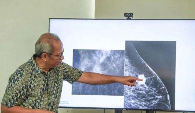 Waspadai Ciri Awal Kanker Payudara, Dokter: Jangan Tunggu Rasa Sakit Muncul