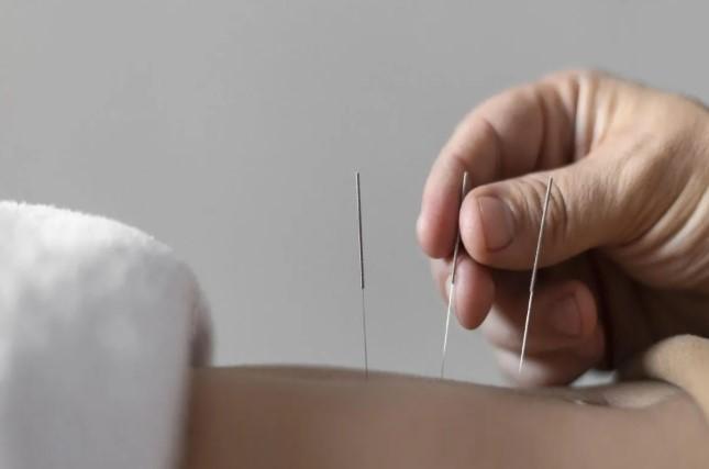 Akupunktur Estetika Wajah Kian Diminati, Dokter Jelaskan Manfaat Medis dan Keamanannya