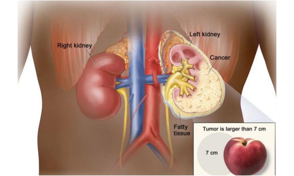 Mengenal Kanker Ginjal, Penyakit yang Diderita Vidi Aldiano