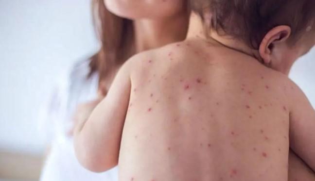 Kasus Campak Masih Tinggi di Indonesia, Dokter Ingatkan Risiko Komplikasi Serius pada Anak