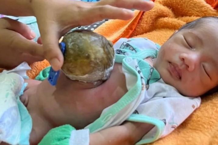 Bayi Penderita Kelainan Usus di Pandeglang Butuh Bantuan Donatur untuk Operasi