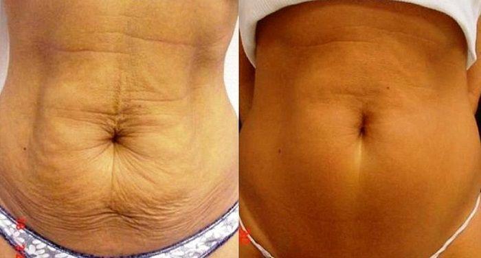 Ini Cara Mengatasi Kulit Bergelambir Setelah Turun Berat Badan