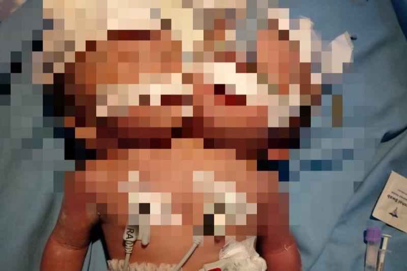 Innalillahi, Bayi Kembar Siam Satu Badan Dua Kepala Meninggal Dunia