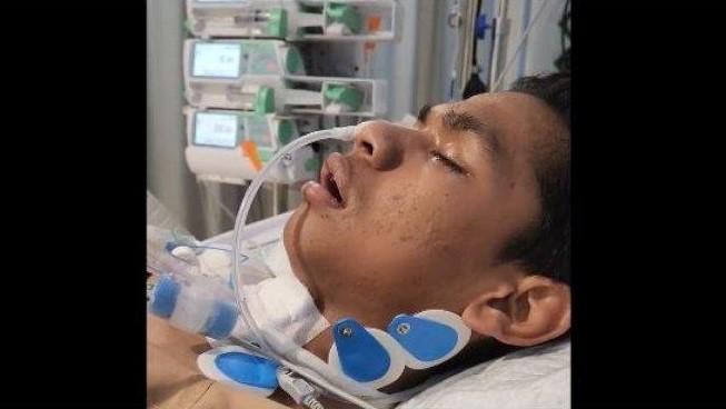 Kasihan, Selang Sepanjang 60 Cm masih Dipasang di Leher David