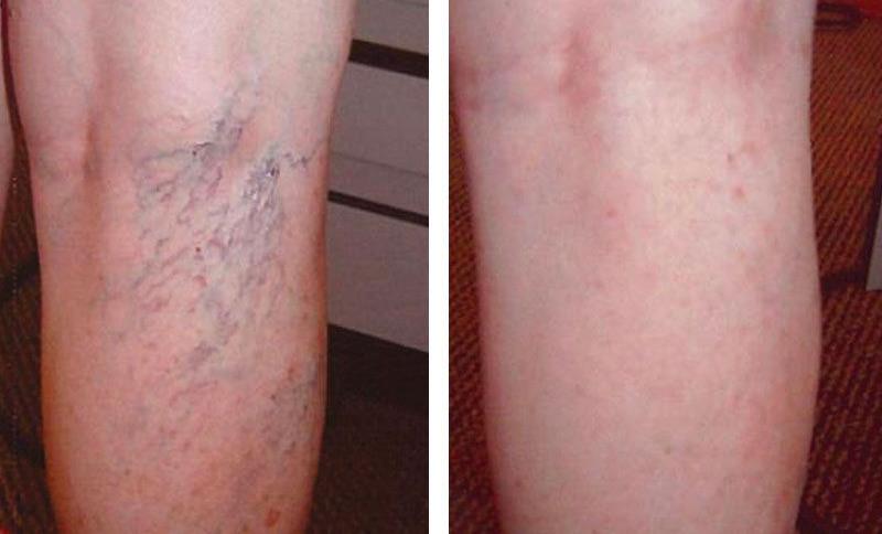 Jangan Disepelekan, Ini Tanda Gangguan Sirkulasi Darah di Kaki