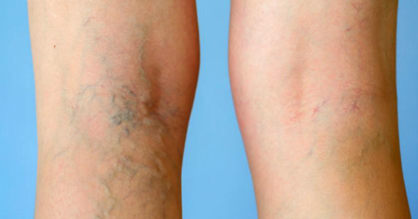 Intip Nih, Tips Ampuh Atasi Varises dengan Make Up