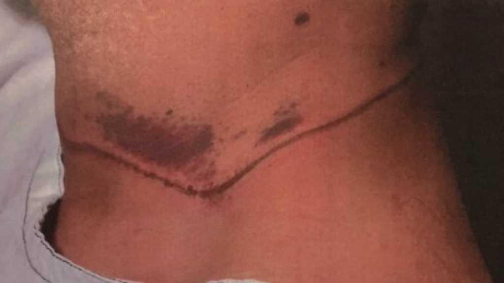 Parah, Pria Ini Jerat Leher Pengungsi Afghanistan dengan Tali Sepatu