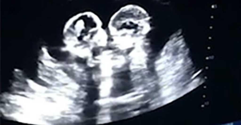 Mengesankan, Dua Bayi Kembar Terlihat Bertengkar di Dalam Rahim