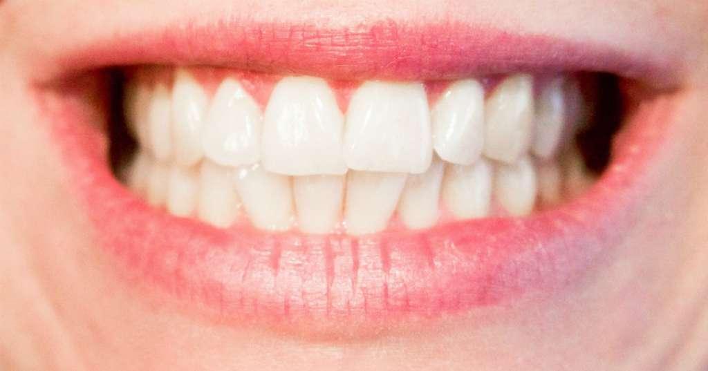 Ingat! Tidak Semua Gigi Boleh Di-Bleaching