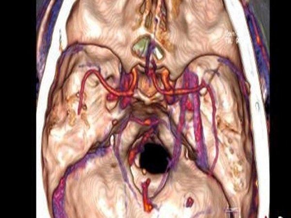 Ngeri, Lima Tahun Lamanya Serpihan Kayu Bersarang di Otak Seorang Pria