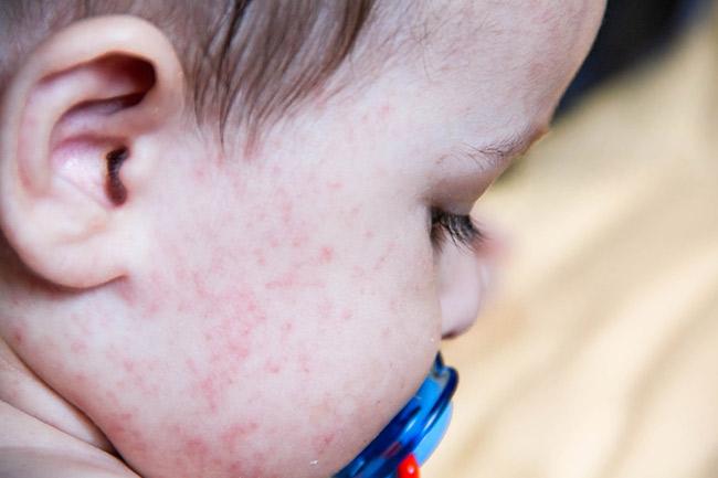 Dermatitis Atopik Lebih Rentan Pada Anak Usia 1-5 Tahun, Kenapa?