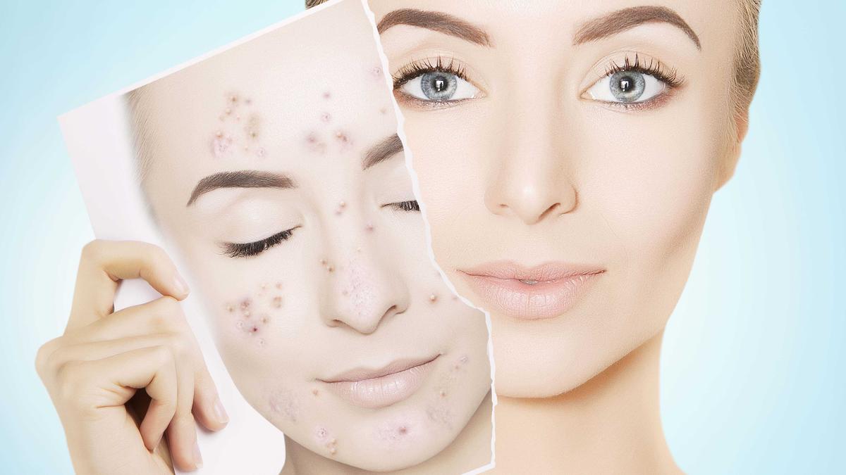 5 Cara Ampuh Hilangkan Wajah Berjerawat Secara Alami untuk Pria dan Wanita