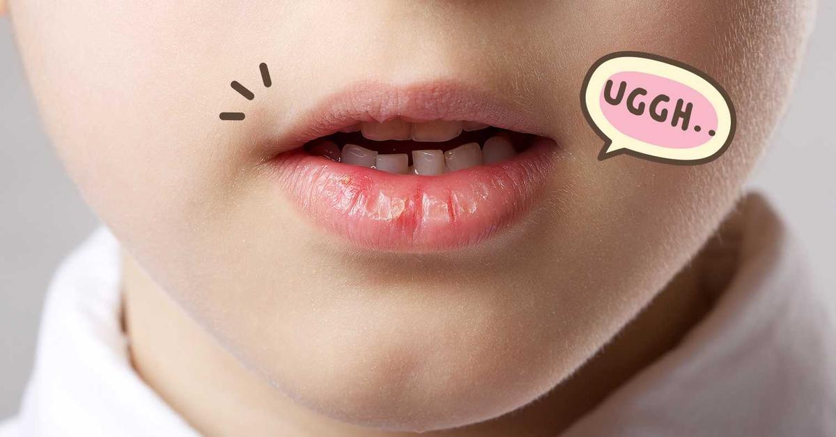 Ini Penyebab Mulut Kering dan Cara Mengatasinya