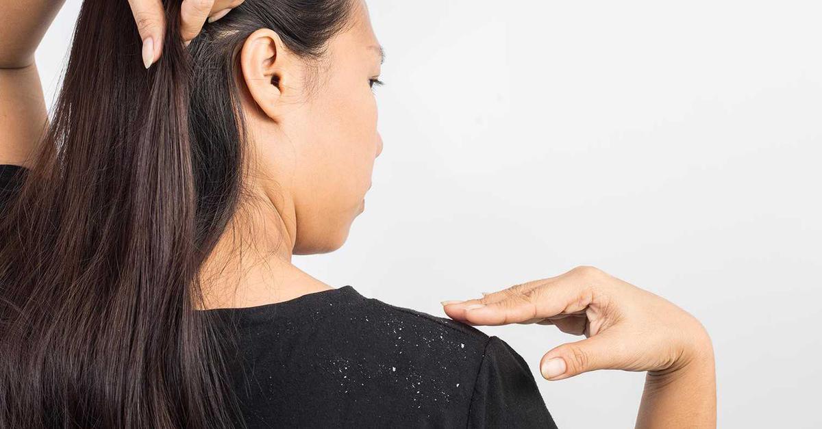 5 Cara Ampuh Menjaga Rambut Terbebas dari Ketombe