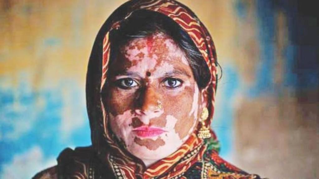 Meski Tidak Mematikan, Penyakit Vitiligo Bisa Sebabkan Depresi