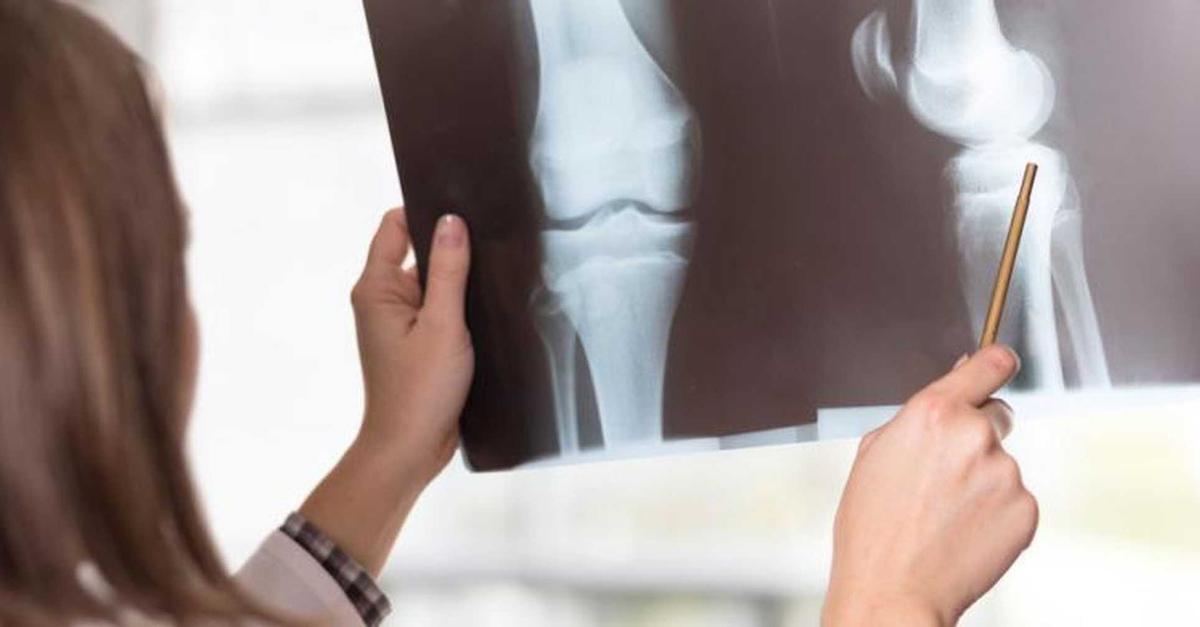 Peneliti Temukan Cara Ampuh Meningkatkan Kepadatan Tulang