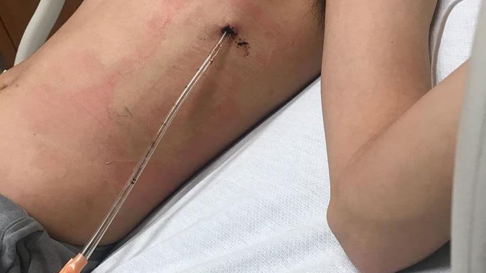 Viral Cerita Eks Abang-None yang Paru-parunya Harus Dilubangi karena Rokok