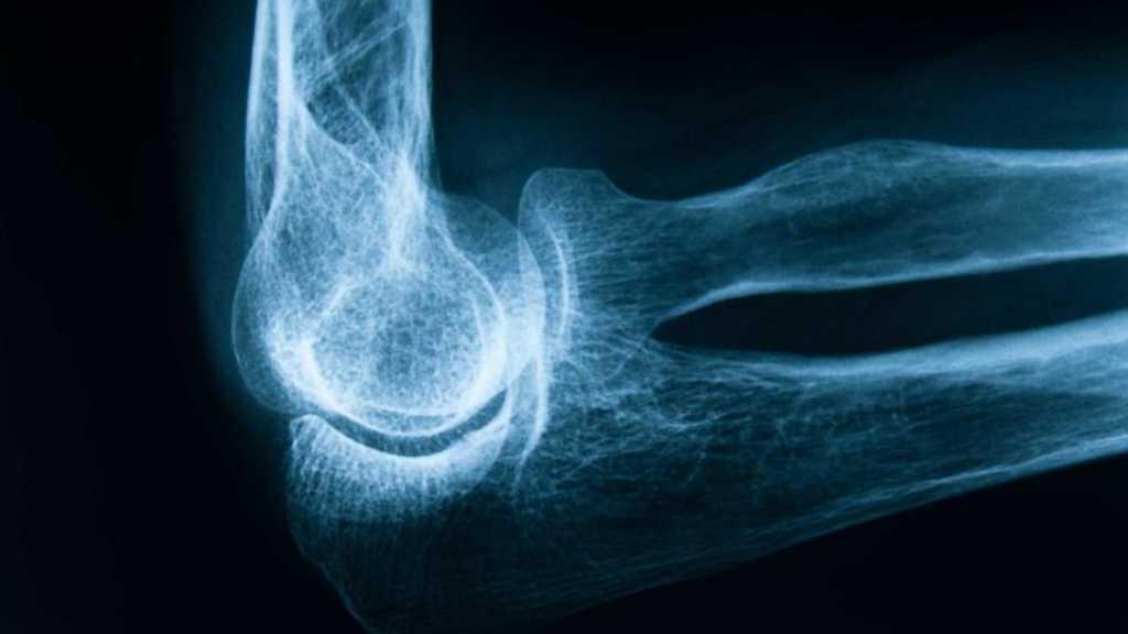 Kenali 5 Tanda Kemungkinan Anda Mengalami Osteoporosis