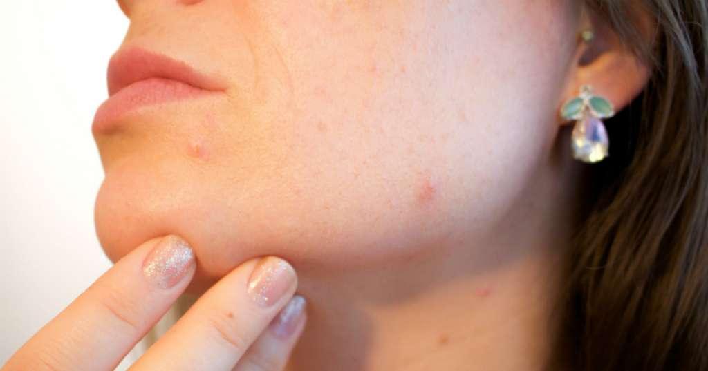 Benarkah 'Facial' Cara Ampuh Hilangkan Jerawat?