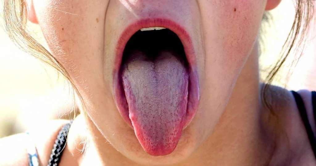 Duh, Lidah Wanita Ini Tiba-tiba Berbulu Setelah Alami Kecelakaan Parah