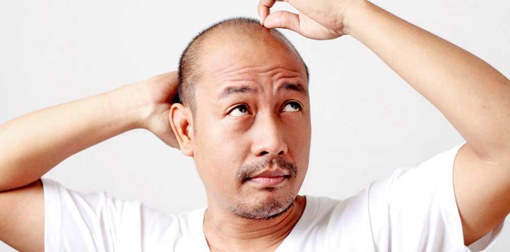 5 Situasi Sulit yang Harus Dialami Oleh Pria Botak