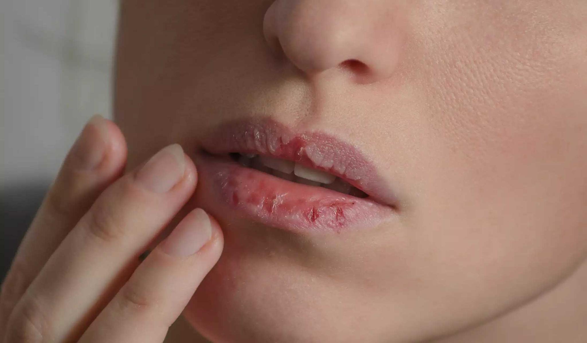 Jangan Sepelekan Bibir Kering! Bisa Jadi Itu Pertanda Penyakit Lain