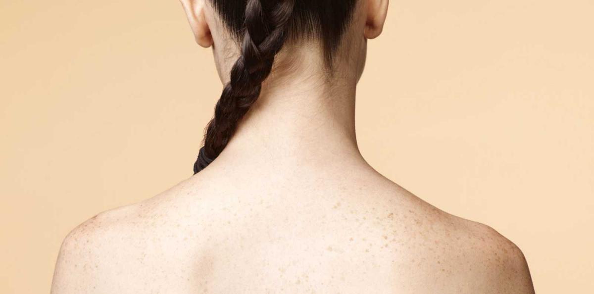 5 Obat yang Ampuh Menghilangkan Jerawat Punggung Secara Alami