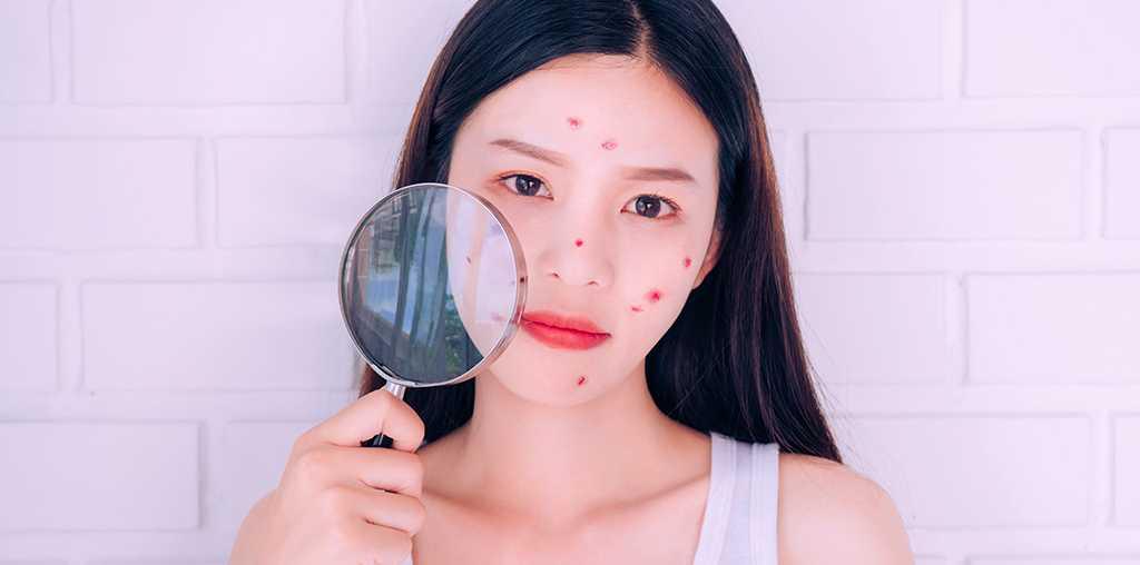 5 Mitos Seputar Jerawat yang Tak Perlu Dipercaya