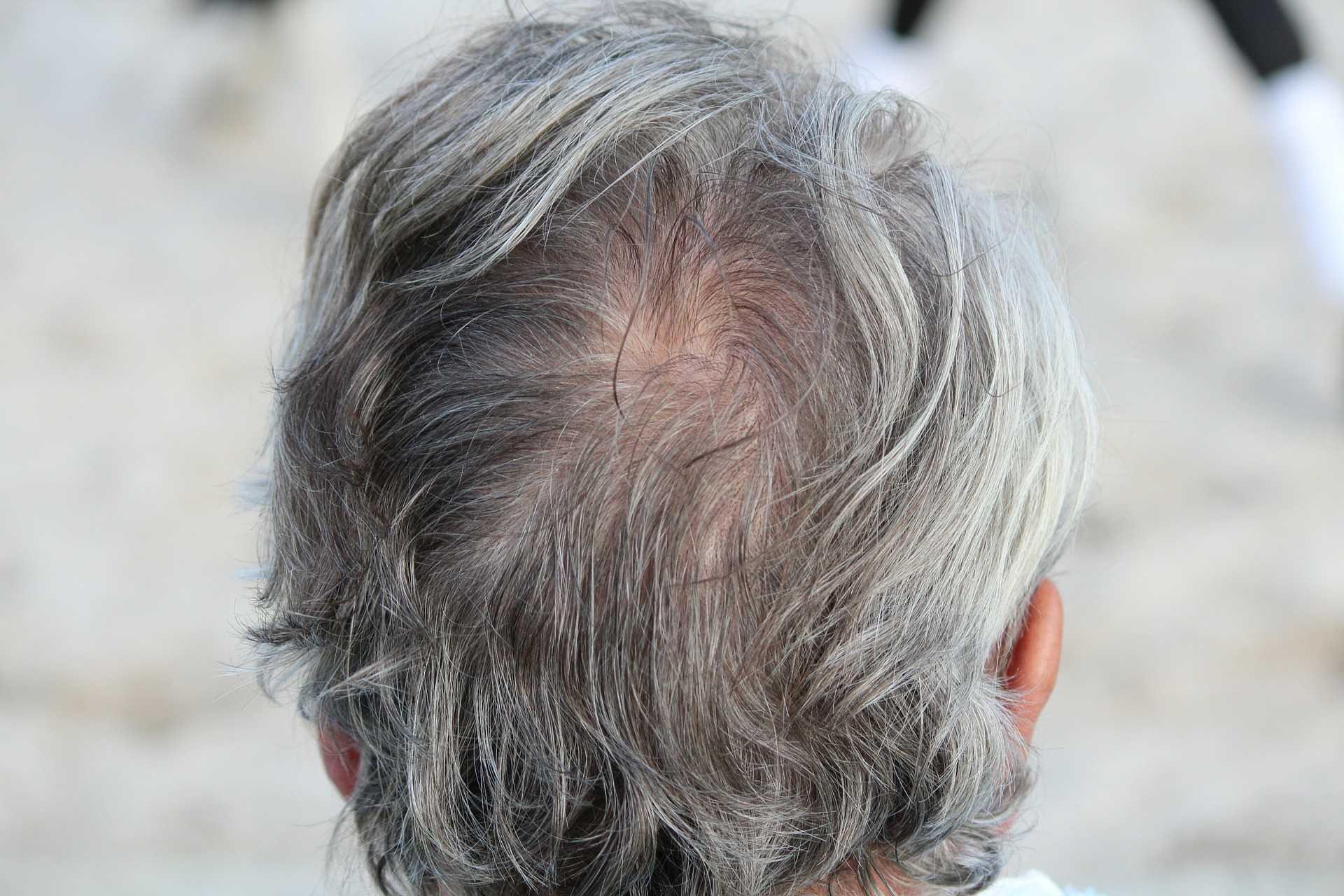 Tinggalkan Kebiasaan Mencabut Uban Jika Tak Ingin Rambut Rontok