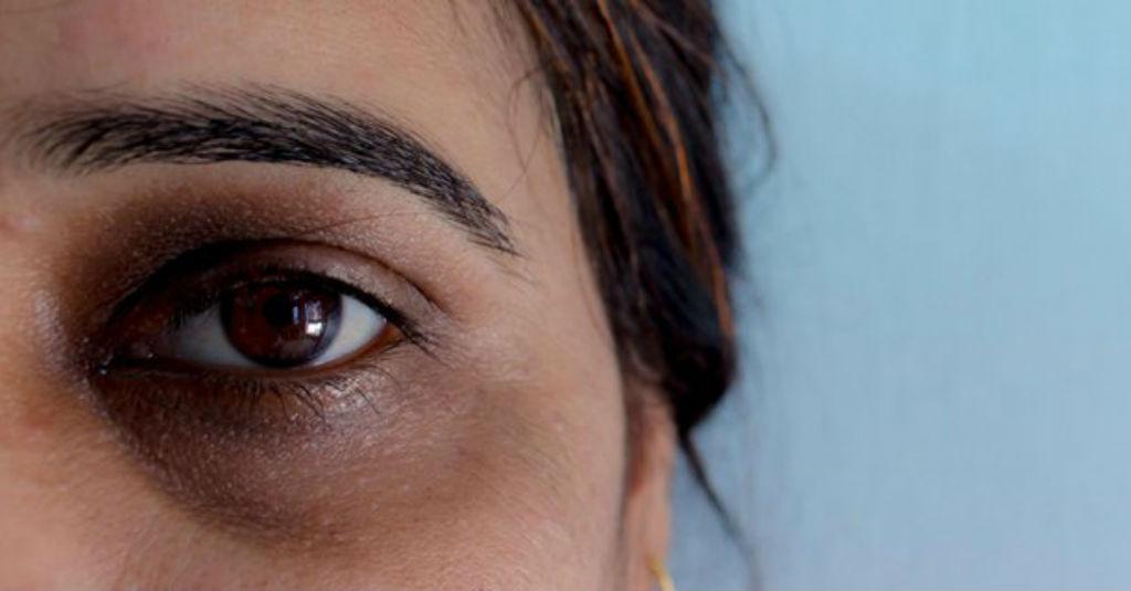 Punya Lingkaran Hitam di Bawah Mata, Begini Cara Menghilangkannya