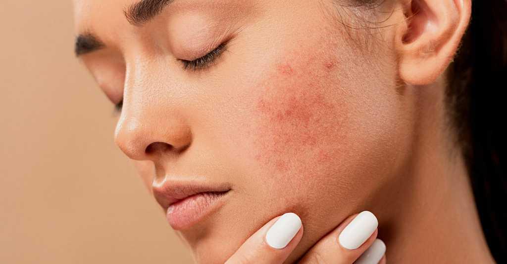 Ini Penyebab Kulit Kering dan Perih Setelah Dibersihkan