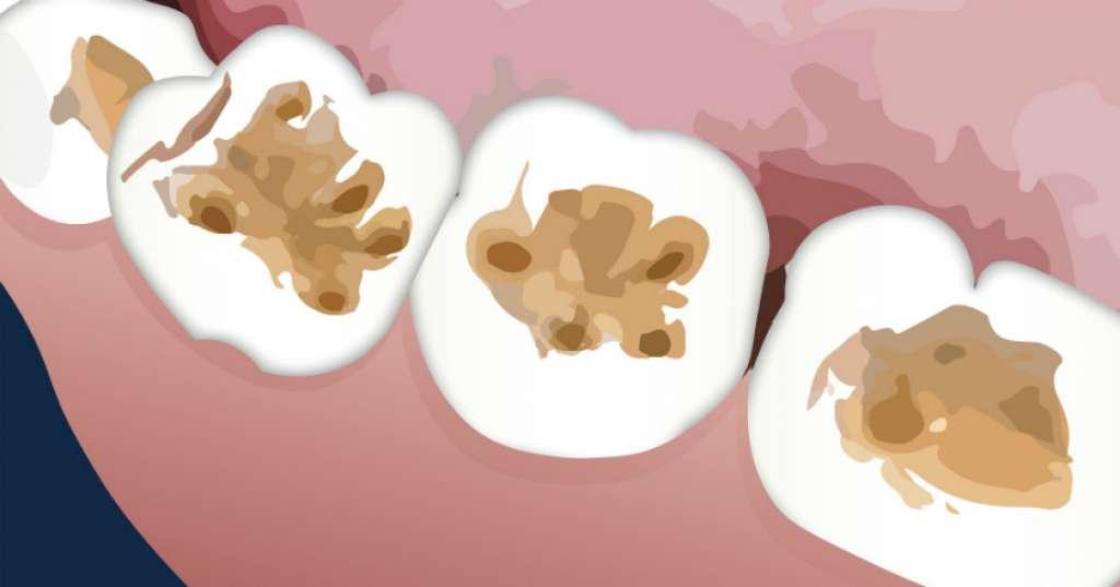 Gigi Berlubang Bisa Menular Lewat Meniup Makanan