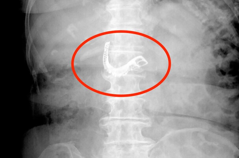 Dikira Hilang, Gigi Palsu Nenek Ini Ternyata Tertelan ke Dalam Perut saat Makan