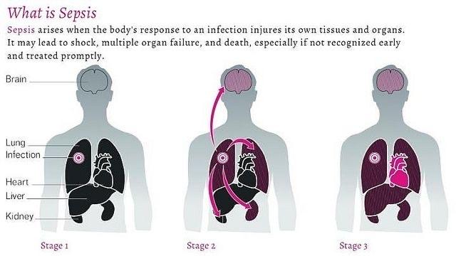 Hari Sepsis Sedunia Diperingati Tiap 13 September, Kenali Gejalanya yang Ancam Jiwa!