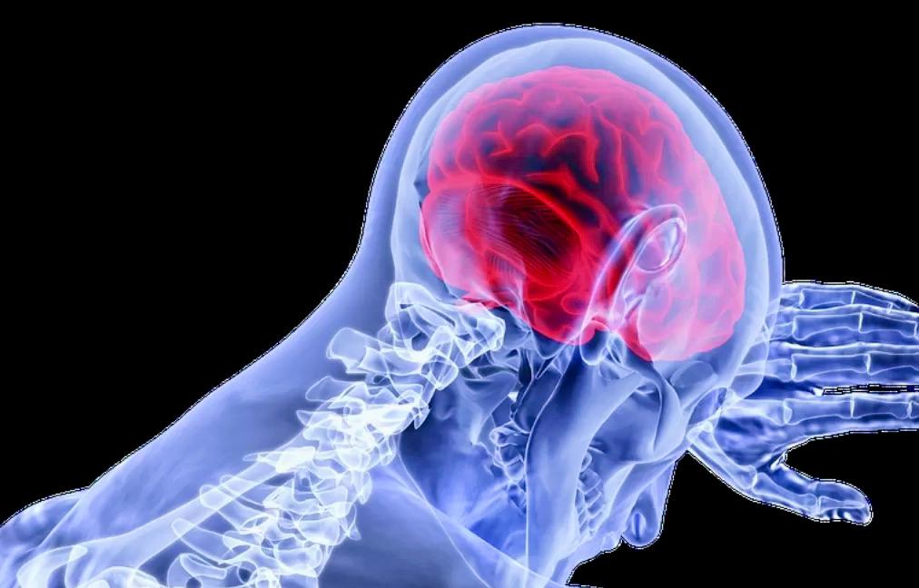 Begini Cara Cegah Stroke di Usia Muda