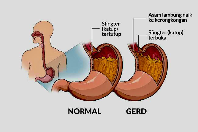 Agar Asam Lambung Tidak Mudah Kambuh, Hindari Kebiasaan Ini