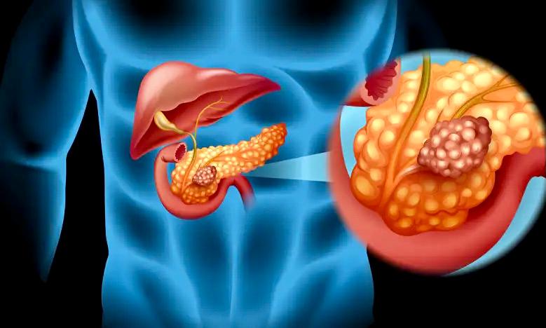 Rizal Ramli Meninggal karena Kanker Pankreas, Ini Gejalanya yang Sering Tak Terdeteksi!