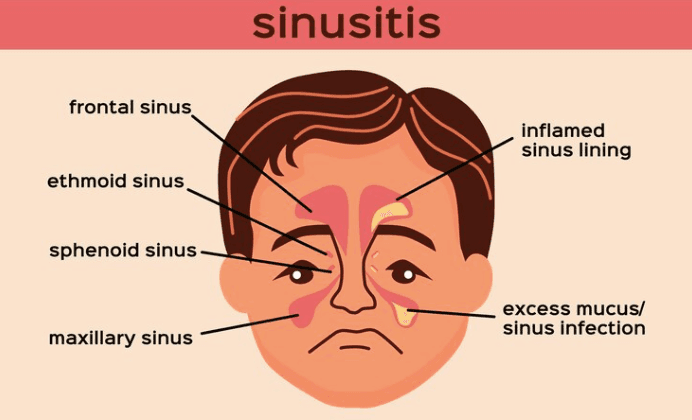 Ramai Soal Mahalini, Apakah Penderita Sinusitis Memang Perlu Menjalani Operasi?
