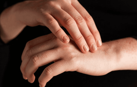 Cara Menghilangkan Gatal di Tangan karena Getah Talas